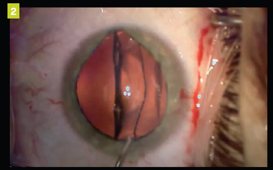Figure 2. ICL placement between the natural crystalline and the iris. 