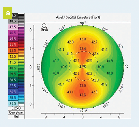 Figure. Understanding Topography in Keratoconus    a. A normal corneal shape on topography clearance across the cornea.