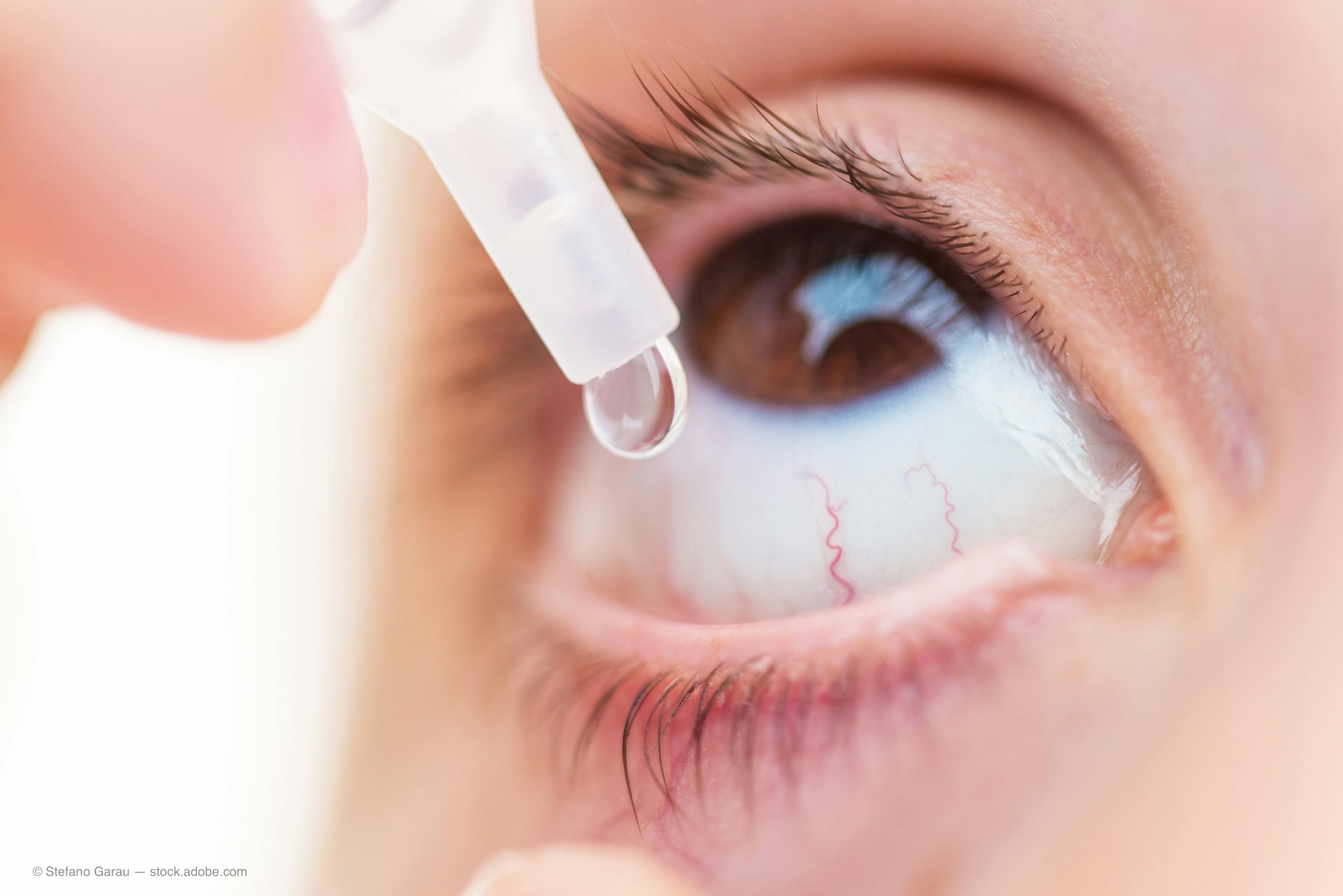 The FDA announced approval of the first generic version of Restasis (cyclosporine ophthalmic emulsion) 0.05% eye drops Thursday.