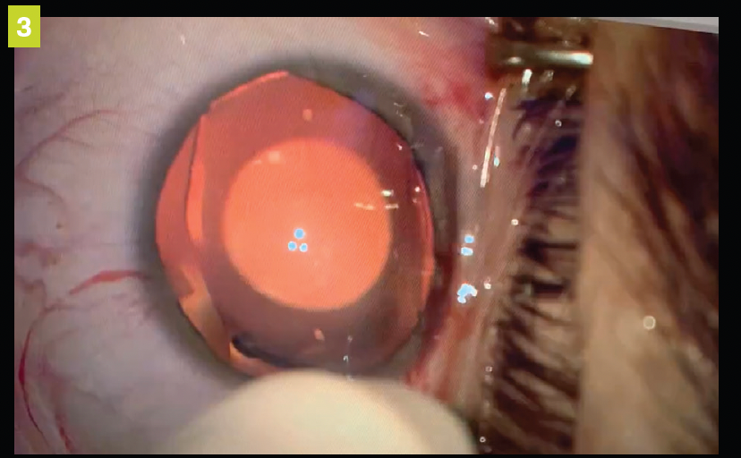 Figure 3. ICL beginning to open once placed in the anterior chamber.