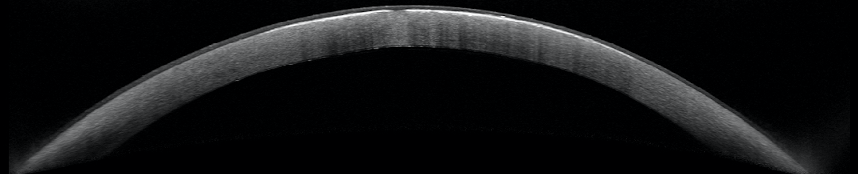 Figure 2. Anterior segment OCT of OD with subepithelial hyper-reflection.