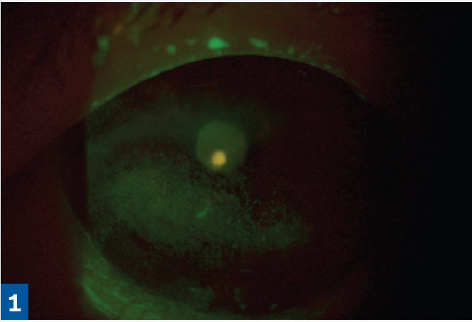 CASE STUDY: A 68-year-old White woman was referred for persistent keratitis OS and failure on multiple medications: