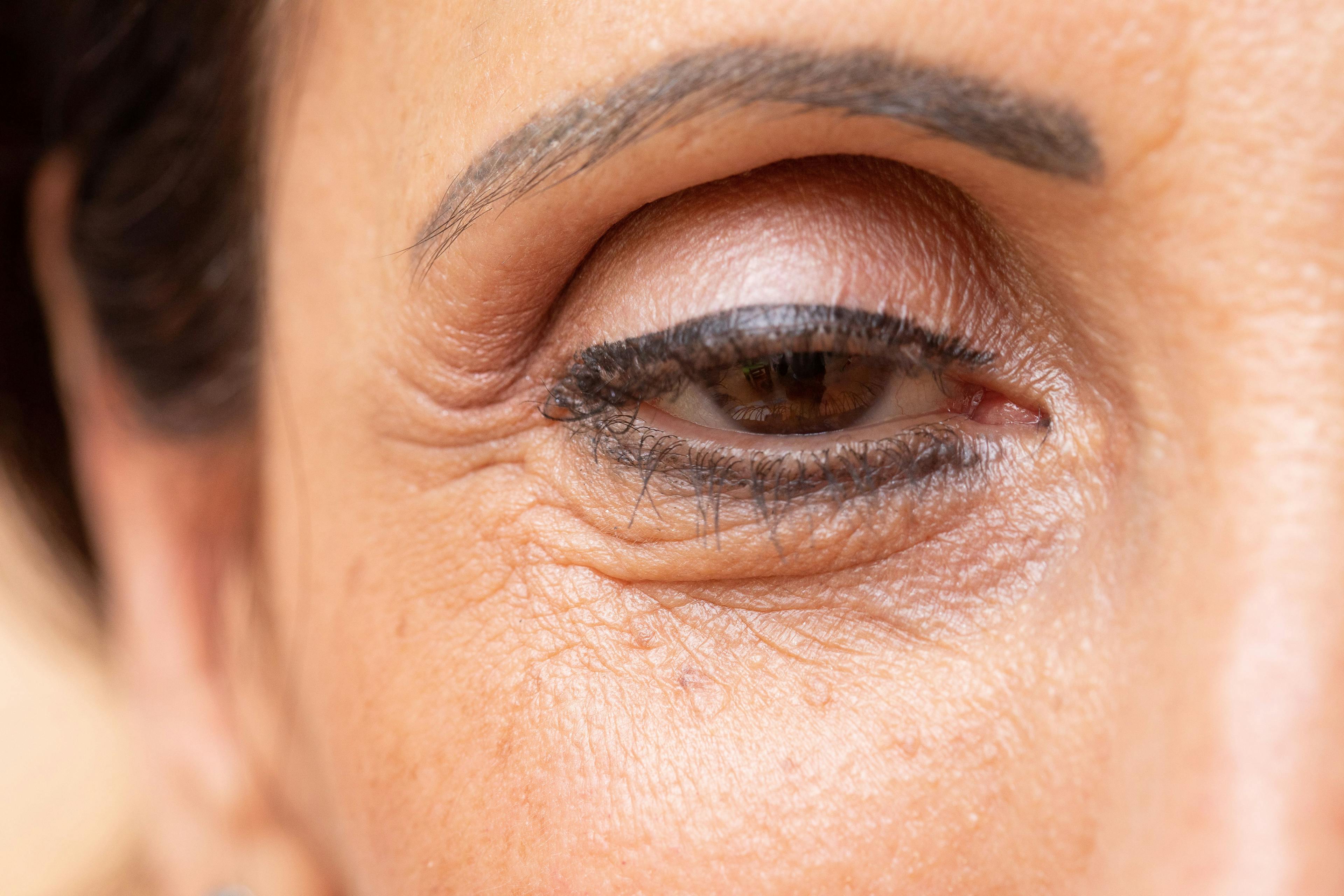 Ptosis therapy gets first-in-category FDA nod
