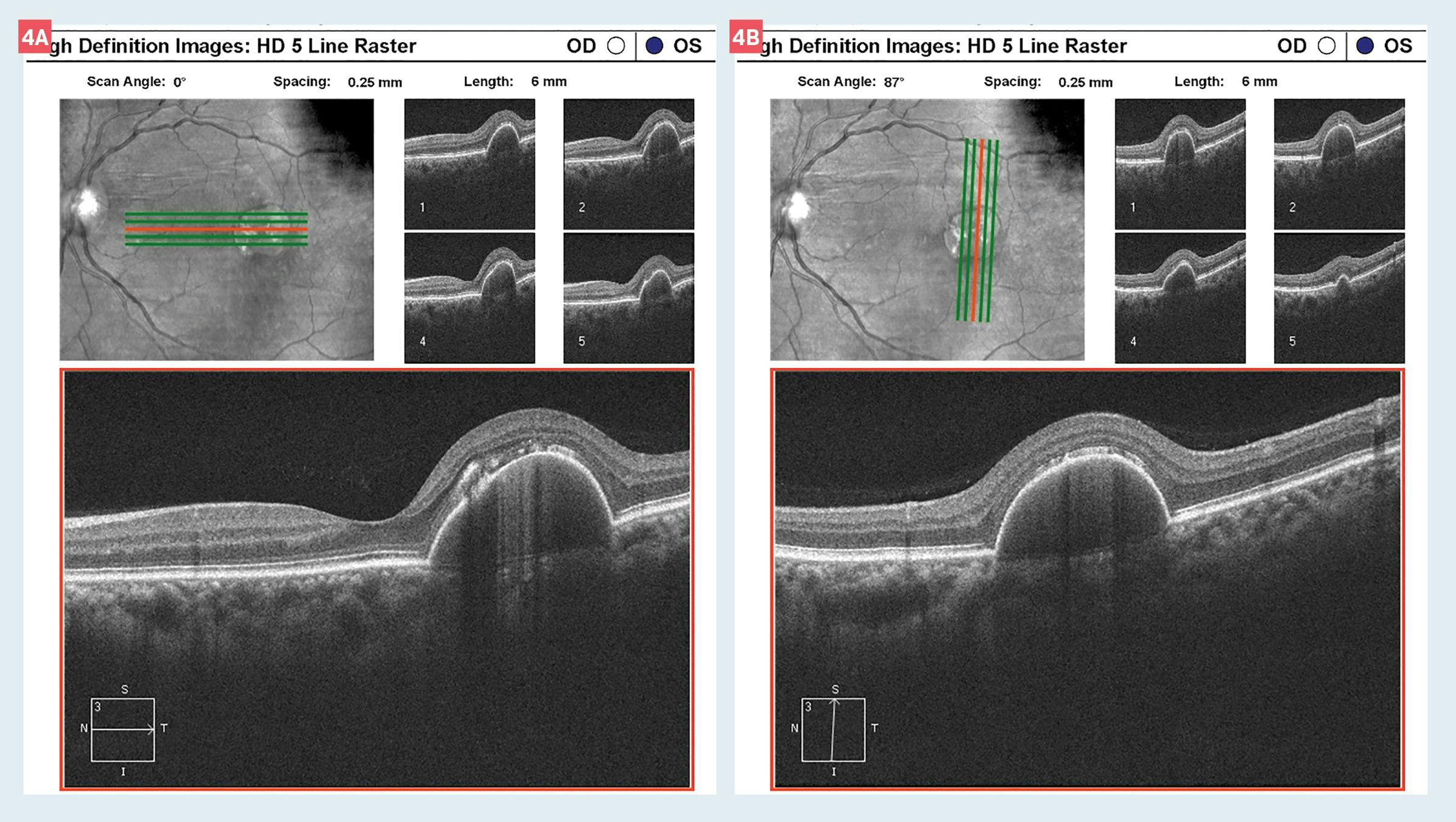 Corresponding optical coherence tomography (OCT) to the five-year follow-up. Note the RPE at the apex of the lesion. Also appreciate that in the left panel, the outer retina in the ellipsoid zone is intact consistent with the preservation of 20/20 VA.
