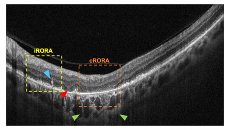 Figure 1. Cross-sectional optical coherence tomography features of geographic atrophy in a 62-year-old female with age-related macular degeneration. iRORA: Incomplete RPE and outer retinal atrophy: variable hypertransmission with intermittent disruption of ellipsoid zone. Note the hyperreflective intraretinal foci within the area of iRORA (blue arrowhead) and the adjacent outer plexiform and inner nuclear layer subsidence (red arrowhead) and hyporeflective wedge; cRORA: Complete RPE and outer retinal atrophy: homogenous choroidal hypertransmission (green arrowheads) and overlying RPE and photoreceptor loss. RPE: Retinal pigment epithelium. (Figures courtesy of Ethan Wohlgemuth, OD)