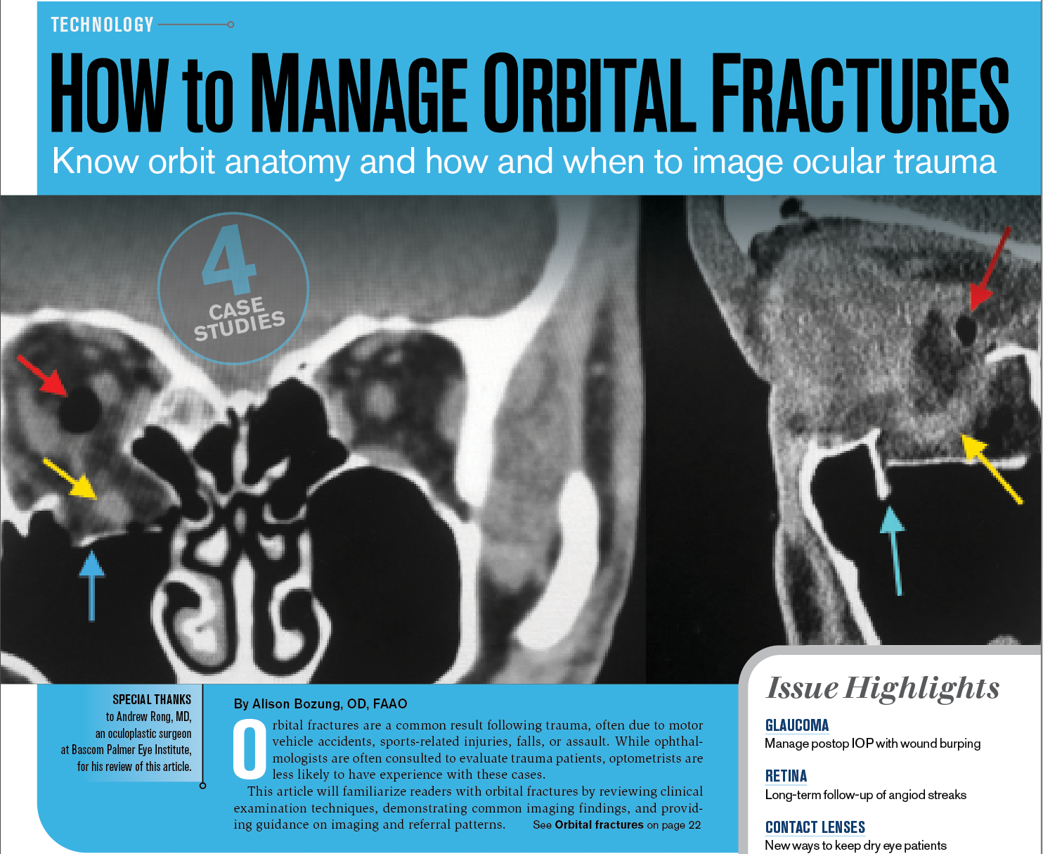How to manage orbital fractures