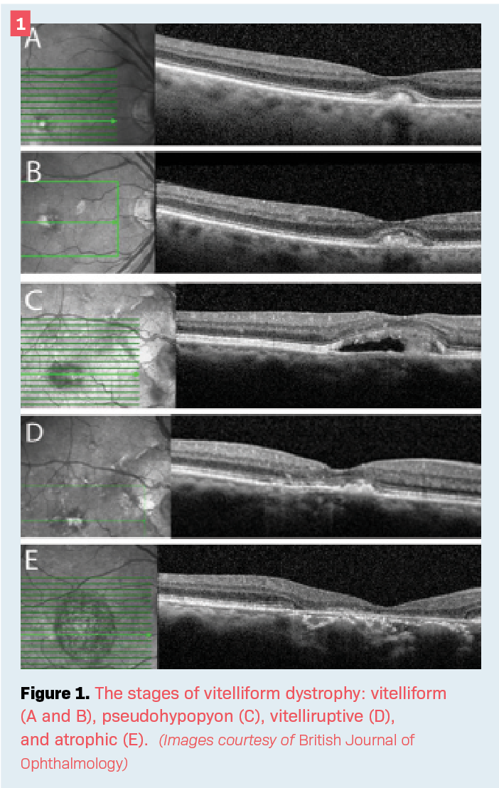 The stages of vitelliform dystrophy: vitelliform (A and B), pseudohypopyon (C), vitelliruptive (D), and atrophic (E).  (Images courtesy of British Journal of Ophthalmology)