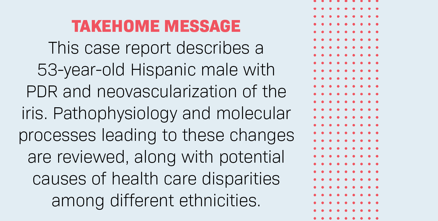 TAKEHOME MESSAGE: This case report describes a 53-year-old Hispanic male with PDR and neovascularization of the iris. Pathophysiology and molecular processes leading to these changes are reviewed, along with potential causes of health care disparities among different ethnicities. 