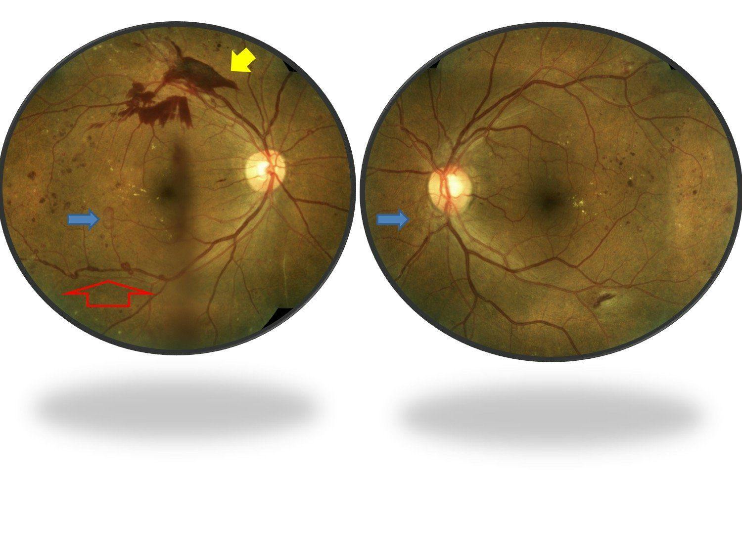 Know the many facets of diabetic retinopathy
