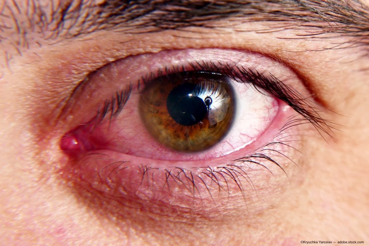 Closeup of red and irritated eye Image Credit: AdobeStock/KryuchkaYaroslav