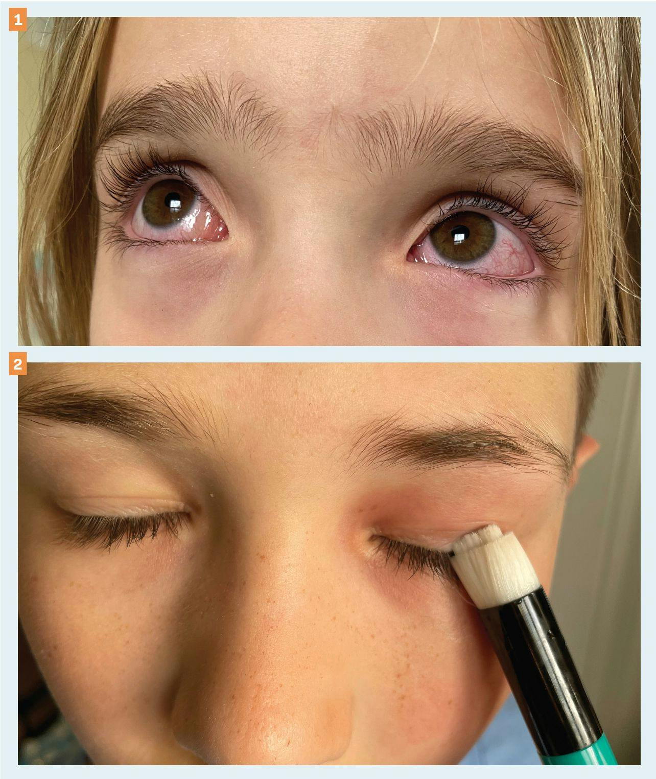 Figure 1. Bilateral conjunctival injection and chemosis in a child. (Image courtesy of Dora Mathe, MS, OD, FAAO, Vanderbilt Eye Institute) Figure 2. Child cleansing lids and lashes with eyelid margin cleansing brush. This can help remove allergens from the surface. (Image courtesy of Shawna L. Vanderhoof, OD, FAAO)