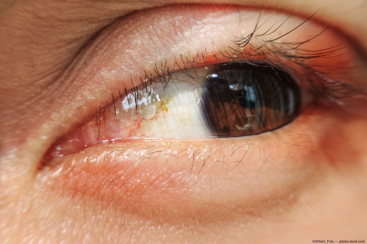 Eyelid inflammation Image credit: ©OHishi_Foto - adobe.stock.com