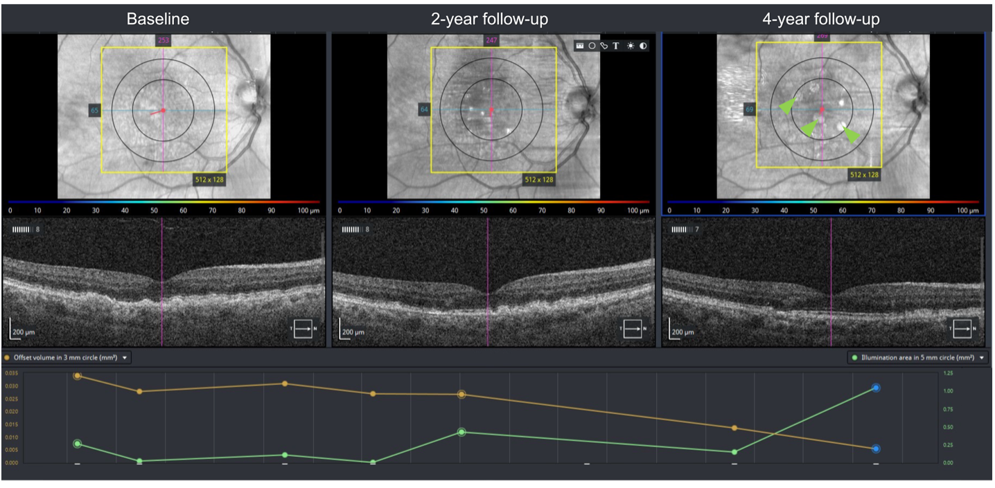 Figure 5. Trend-based analysis of geographic atrophy progression in the right eye over 4 years. Top row: Serial near-infrared reflectance imaging (NIR). Development of GA represented by round hyperreflective lesions (green arrowheads) is noted at the 4-year follow-up; middle row: serial cross-sectional optical coherence tomography through the fovea. A decrease in drusen volume can be appreciated from baseline to the 4-year follow-up; bottom row: Cirrus Advanced RPE trend analysis (Carl Zeiss Meditec, Inc., Dublin, CA, USA). Orange line: RPE elevation volume (correlate of drusen volume) within the central 3mm. Green line: sub-RPE illumination area (correlate of cRORA choroidal hypertransmission area) within the central 5mm. RPE: Retinal pigment epithelium. cRORA: complete RPE and outer retina atrophy. Drusen volume at baseline was high, 0.035mm3. With sequential follow- up, central drusen volume decreased as the area of cRORA increased.