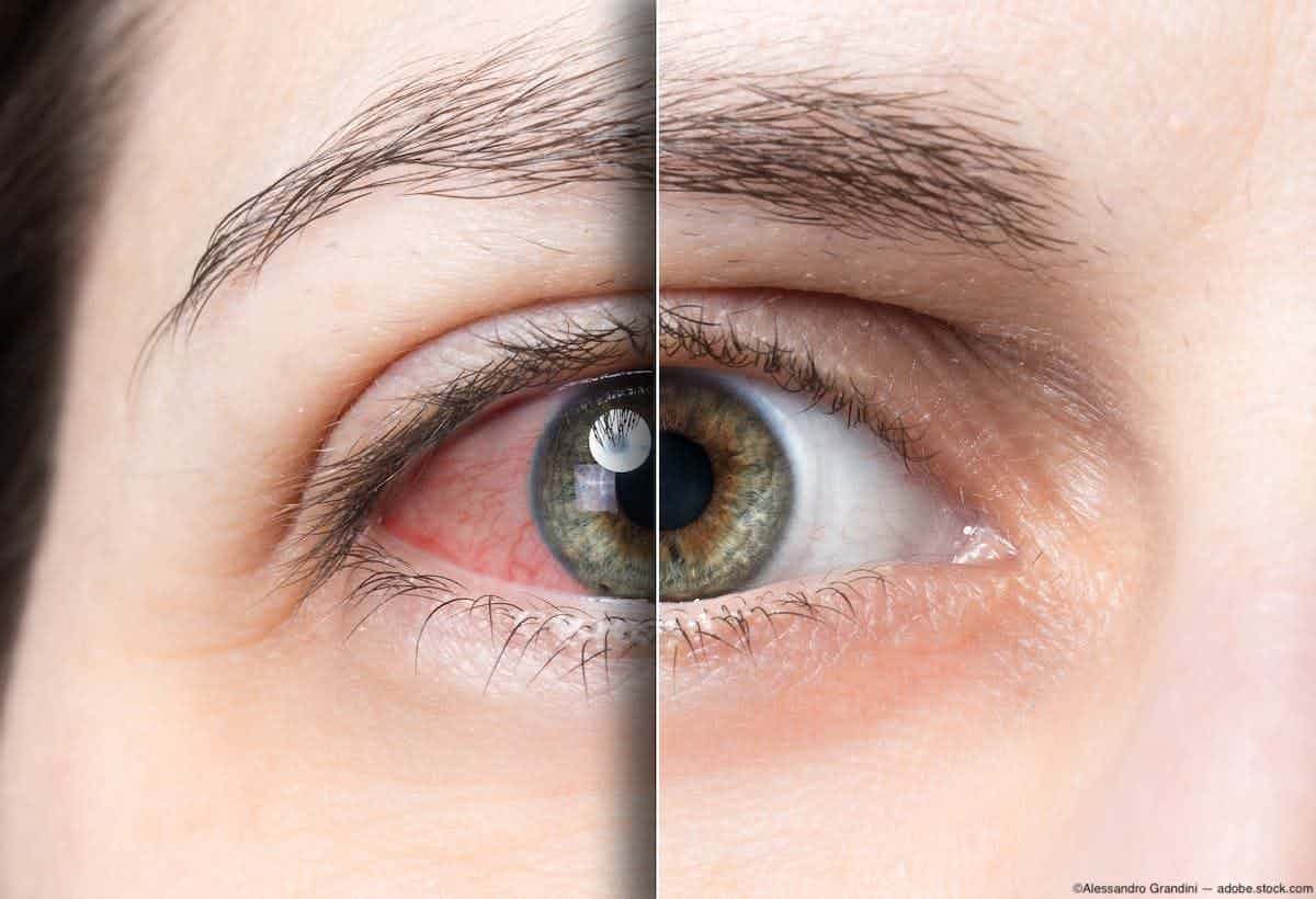 Split image of dry eye before and after treatment Image credit: ©Alessandro Grandini - adobe.stock.com