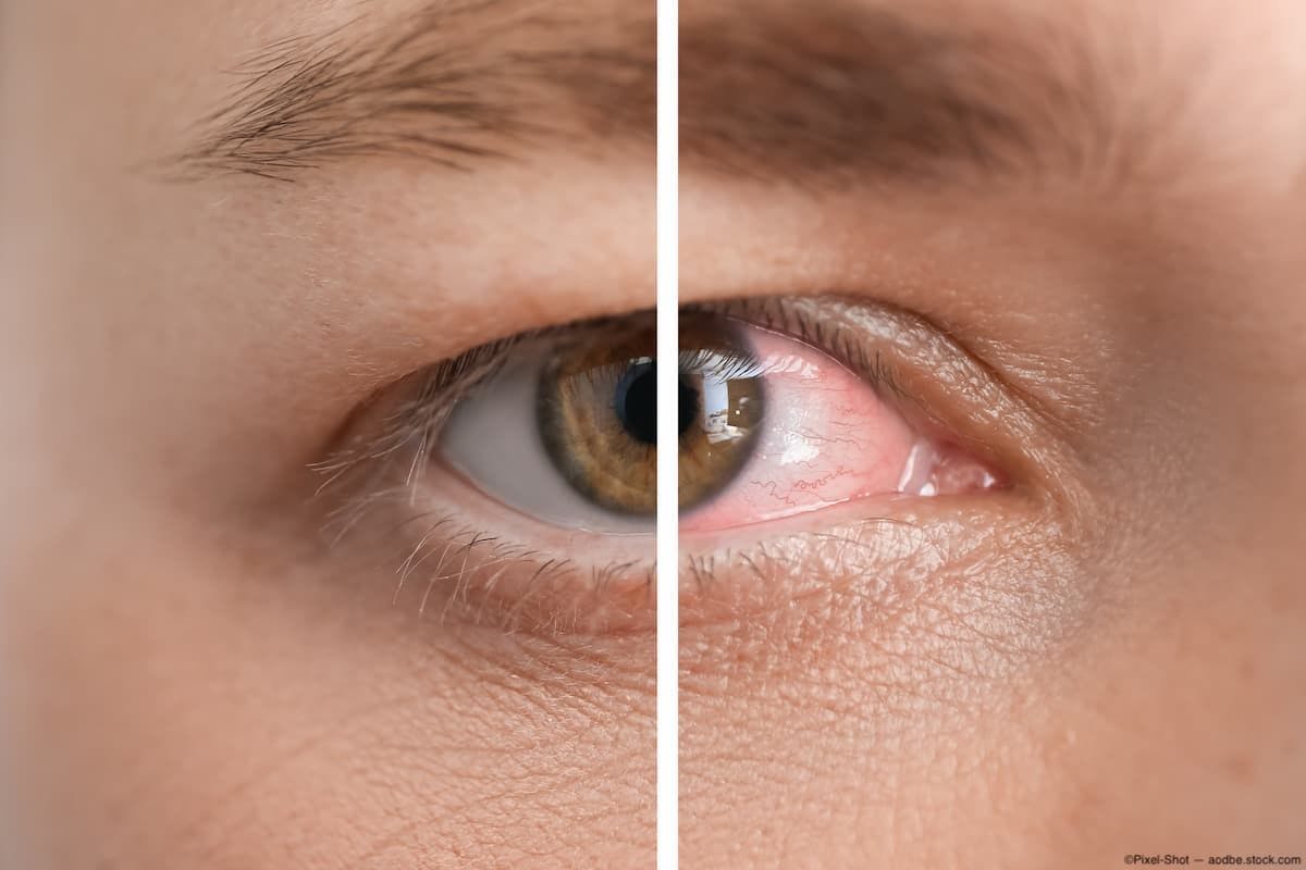 Before and after closeup of dry eye treatment Image Credit: AdobeStock/Pixel-Shot