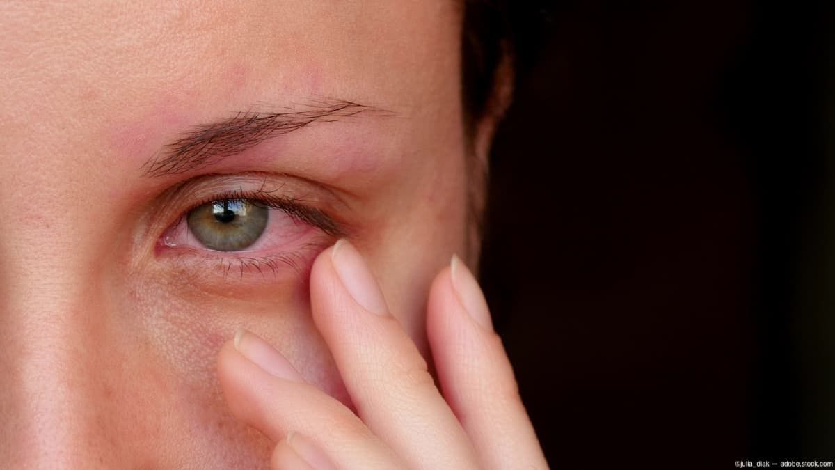 Woman touching irritated eye Image credit: AdobeStock/julia_diak