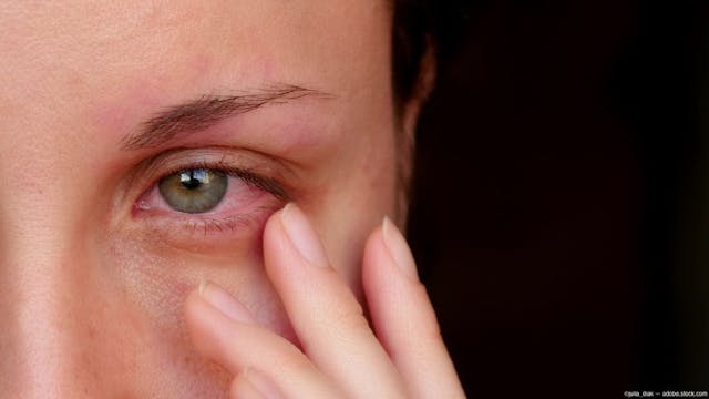 Woman touching irritated eye Image credit: ©julia_diak - adobe.stock.com