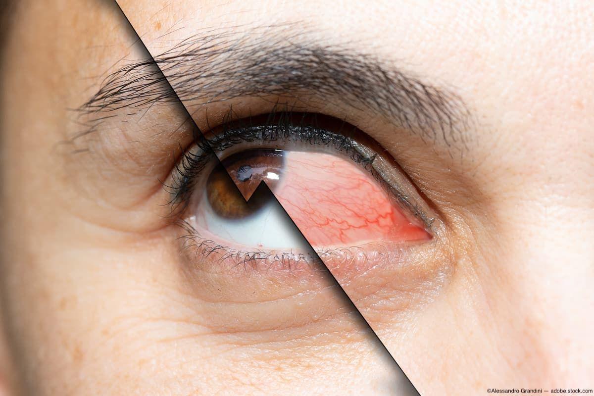 Eye split into graphic of healthy and irritated Image credit: AdobeStock/AlessandroGrandini