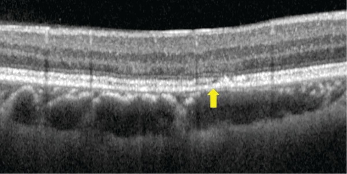 Figure 3. In a case of pachychoroid pigment epitheliopathy, a pachyvessel compresses the Sattler layer and choriocapillaris and causes focal retinal pigment epithelium and ellipsoid zone disruption, which clinically appears as pigment changes. Note the normal appearance outside the area. Image courtesy of Jim Williamson, OD, FAAO, FORS.