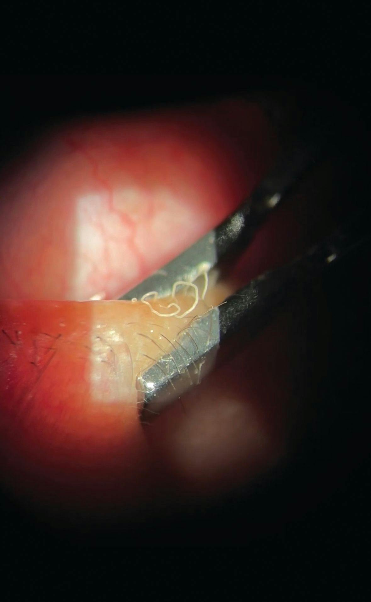 A slit-lamp video of meibomian gland expression educates patients on condition. Image credit: Jaclyn Garlich, OD, FAAO