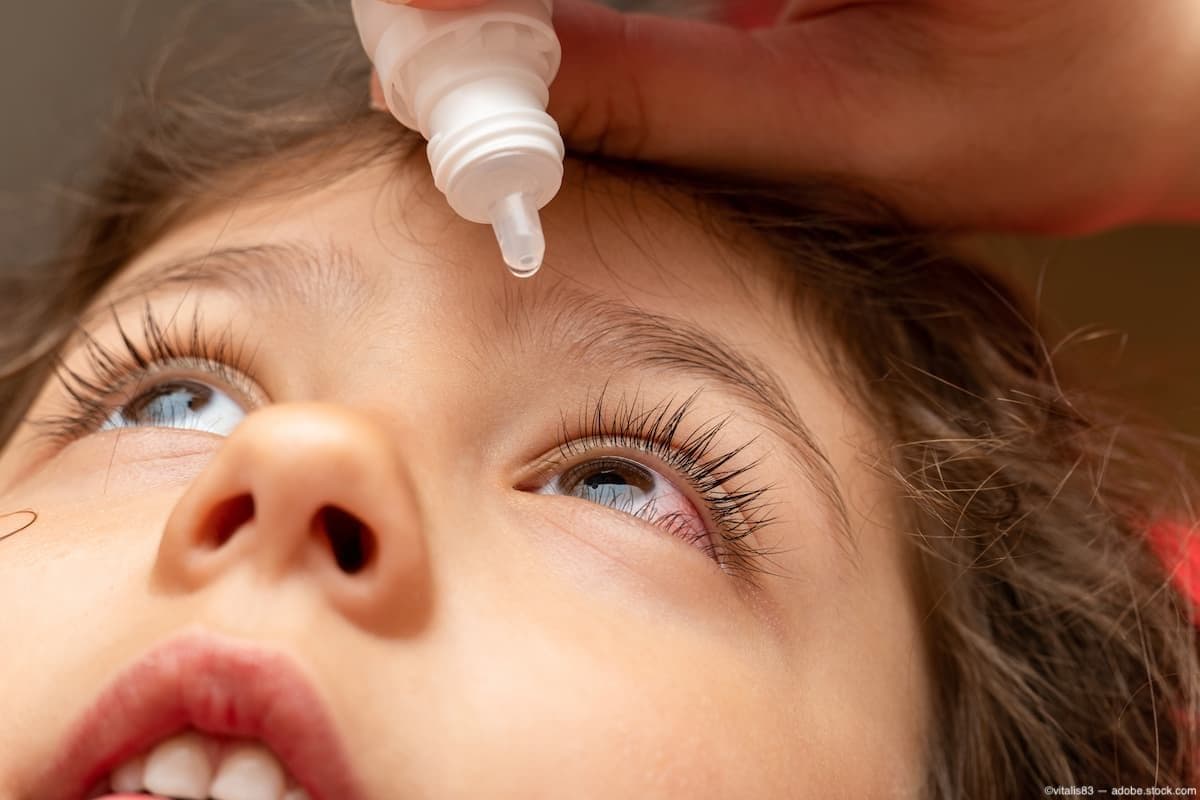 Eye drops being administered to child Image credit: Adobestock/vitalis83