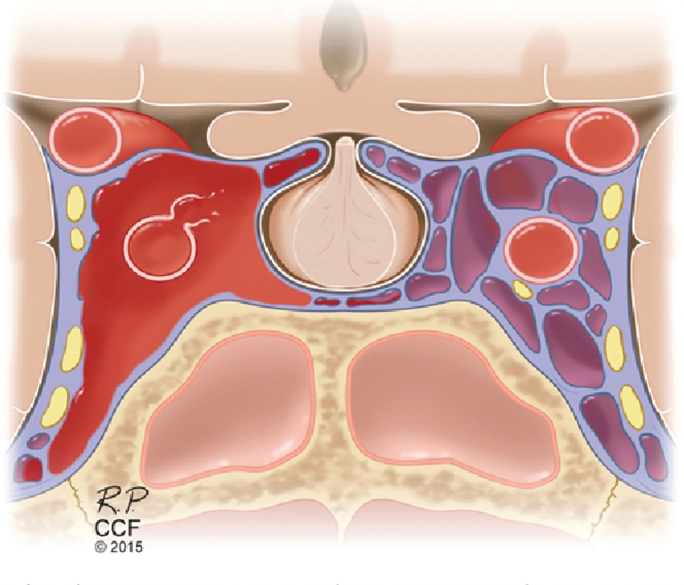 Schematic of carotid-cavernous fistula in coronal section. (Image courtesy of Min Lang, MD, MSc; Ghaith Habboub, MD; Jeffrey P. Mullin, MD, MBA; and Peter A. Rasmussen, MD)