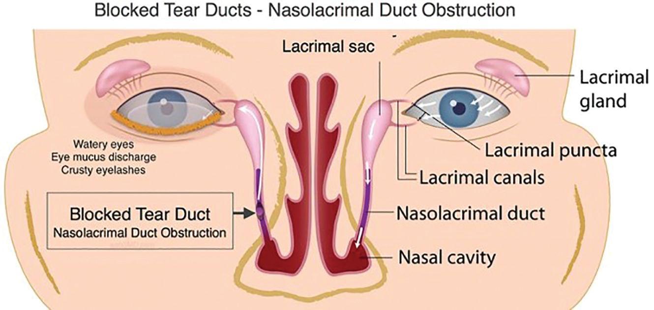 The compounding effects of blocked tear ducts. (Image courtesy of alila07/dreamstime.com)