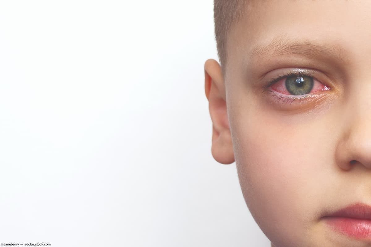 Young boy with inflamed eye Image credit: ©Janeberry - adobe.stock.com
