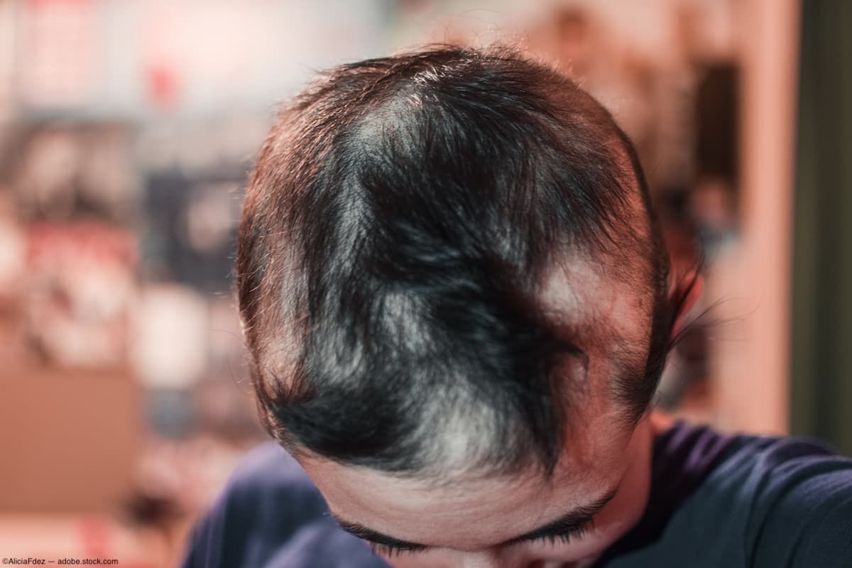 Top of man's head who has alopecia Image credit: ©AliciaFdez - adobe.stock.com