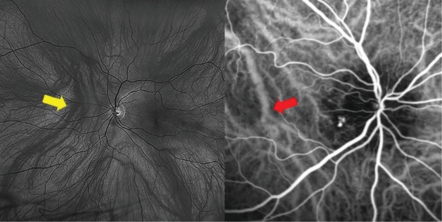 Figure 2a. Red-channel ultrawidefield image demonstrating nasal vortex vein anastomosis (yellow arrows). Figure 2b. Anastomosis occurring at the horizontal watershed zone (red arrow) as shown with indocyanine green angiography. Images courtesy of Jim Williamson, OD, FAAO, FORS.