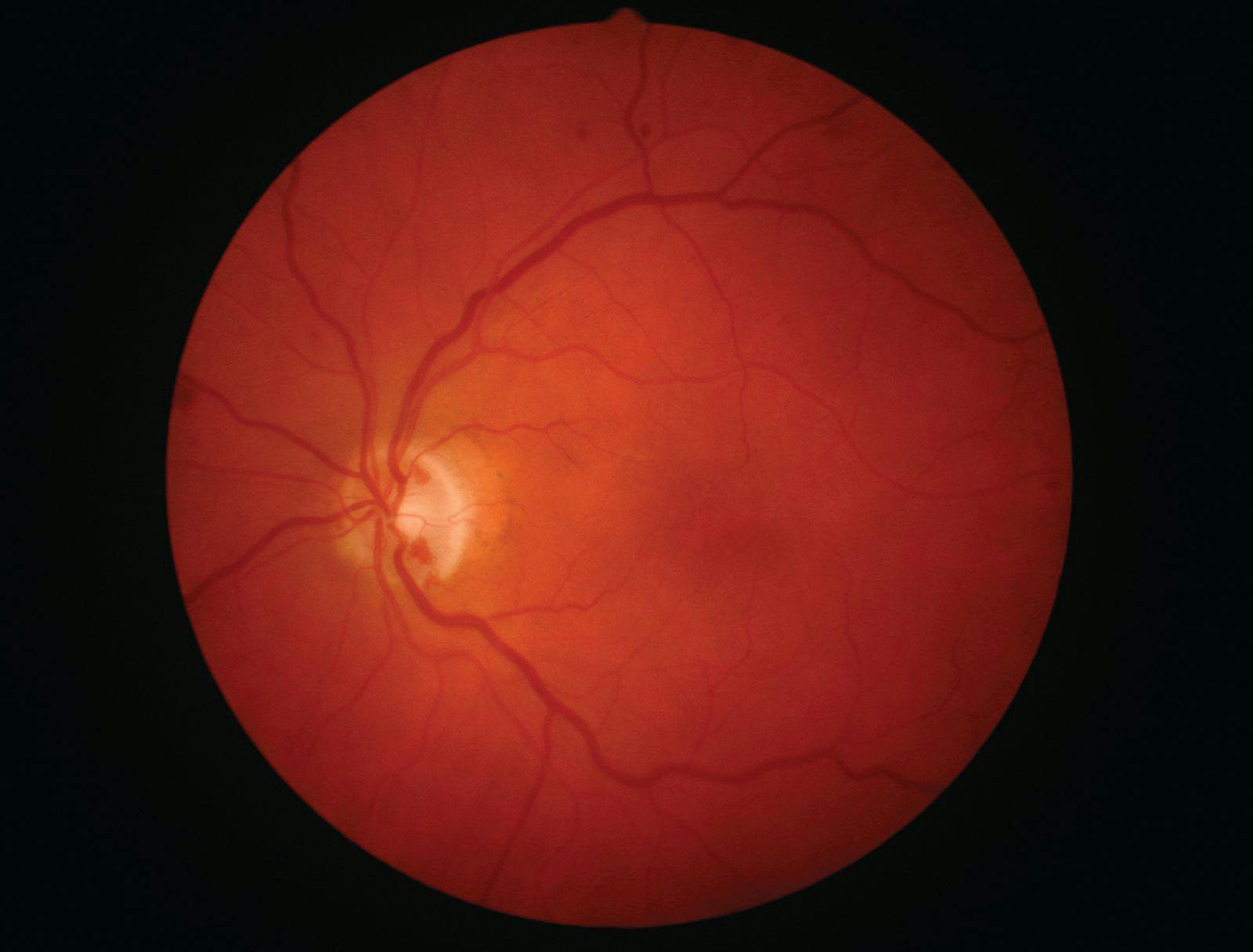 Image of retina taken from patieent with proliferative diabetic retinopathy