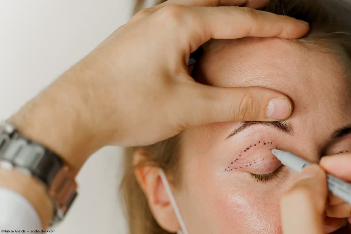 Patient's eyelid being prepped for blepharoplasty procedure Image credit: AdobeStock/RabizoAnatolii