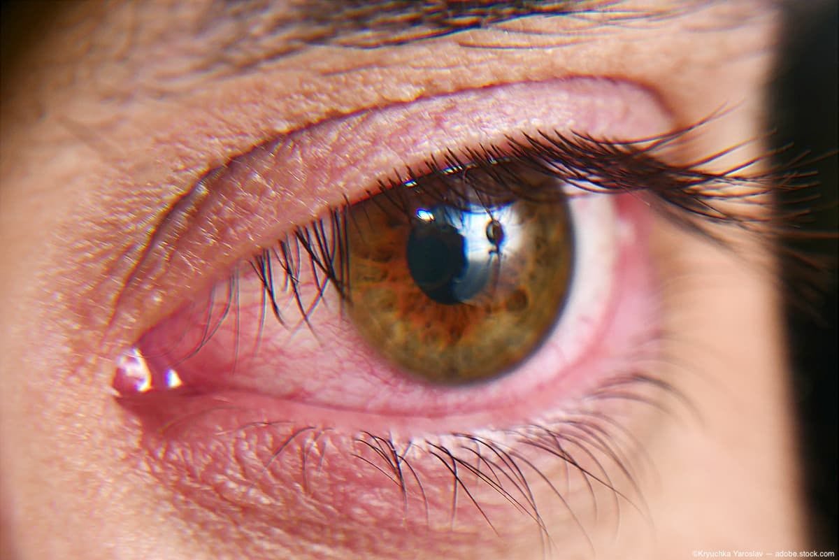 Closeup of inflamed eye Image credit: ©Kryuchka Yaroslav - adobe.stock.com