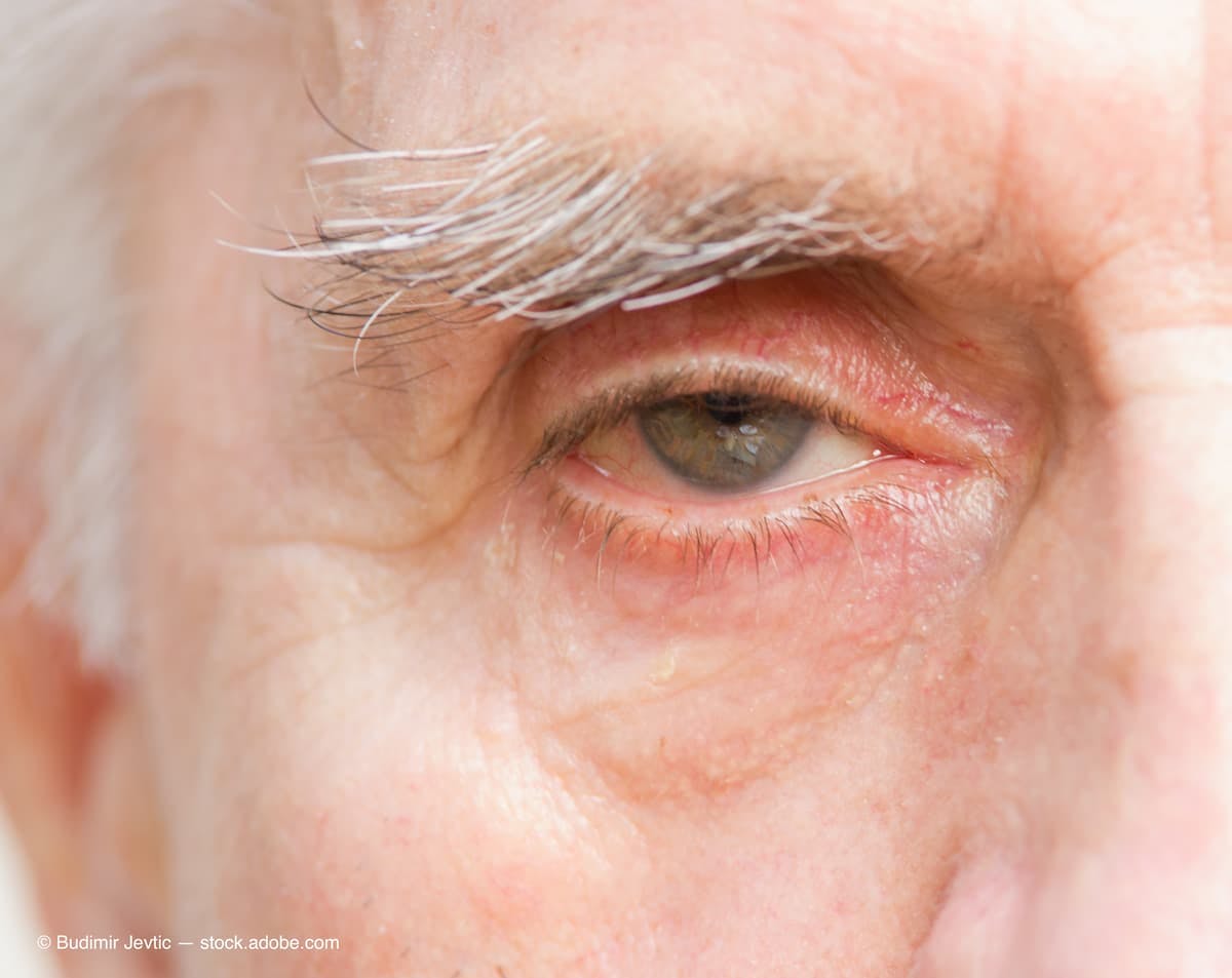 Closeup of older man's eye Image credit: ©Budimir Jevtic - adobe.stock.com