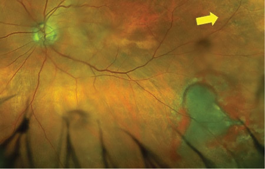 Figure 8. Inferior temporal equatorial variegated hemorrhage in a patient with peripheral exudative hemorrhagic chorioretinopathy. Notice the conglomeration of drusen temporally (yellow arrow). Images courtesy of Jim Williamson, OD, FAAO, FORS.