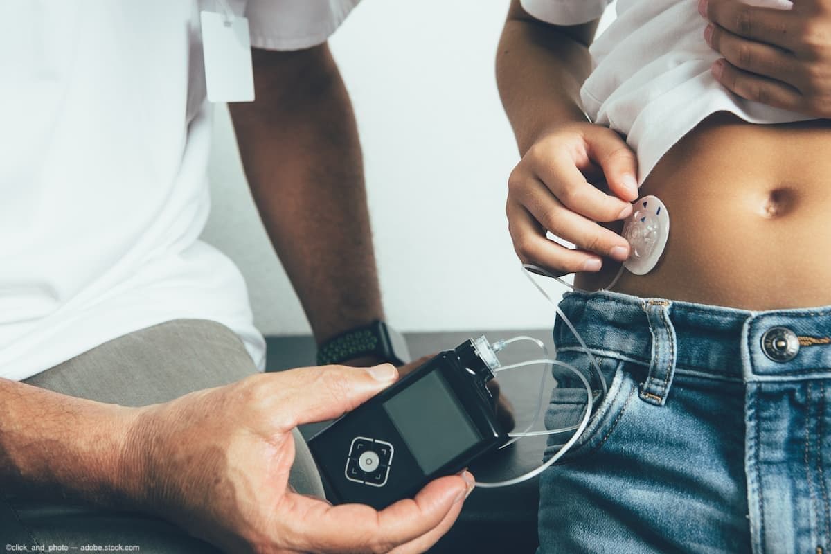 Child has insulin pump attached to stomach Image credit: AdobeStock/click_and_photo