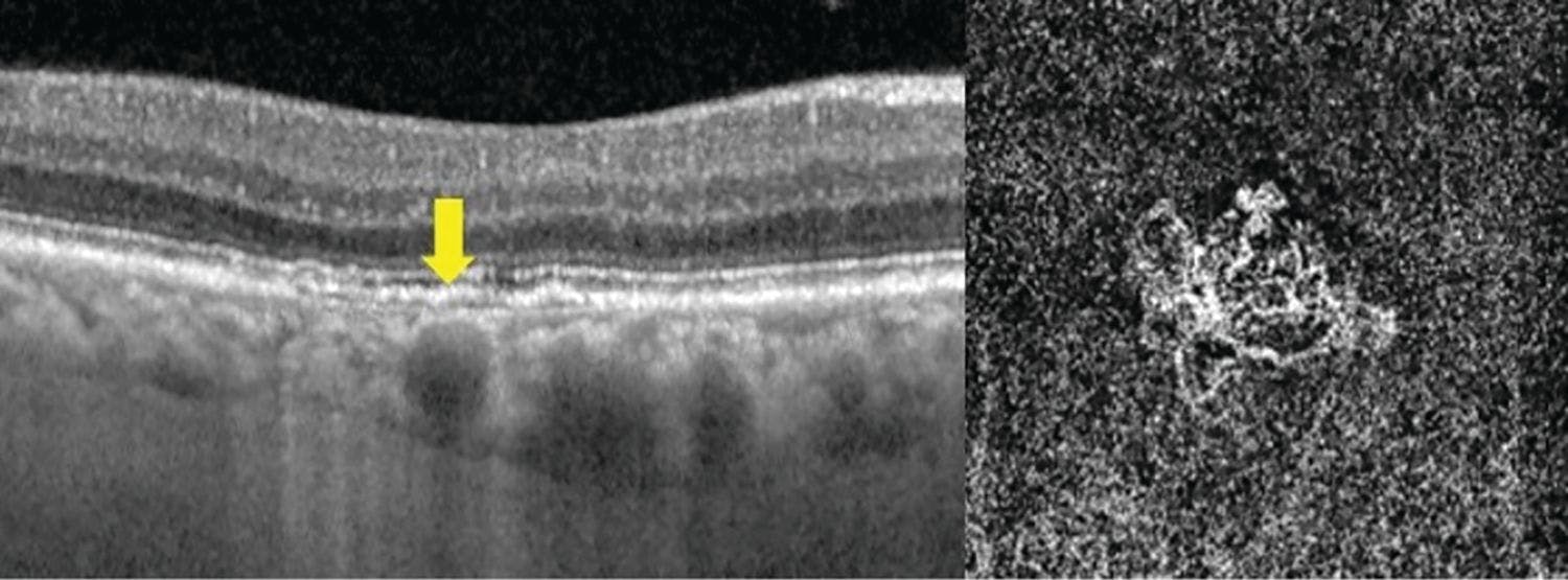 Figure 5a. A 59-year-old patient previously diagnosed with unilateral age-related macular degeneration. The double-layer sign is present with a pachyvessel located directly below compressing the Sattler layer and choriocapillaris (yellow arrow). Drusen were not present. The patient’s diagnosis was reclassified to pachychoroid neovasculopathy. Figure 5b. A type 1 macular neovascularization membrane in another pachychoroid neovasculopathy patient with the double layer sign. Image courtesy of Jim Williamson, OD, FAAO, FORS.