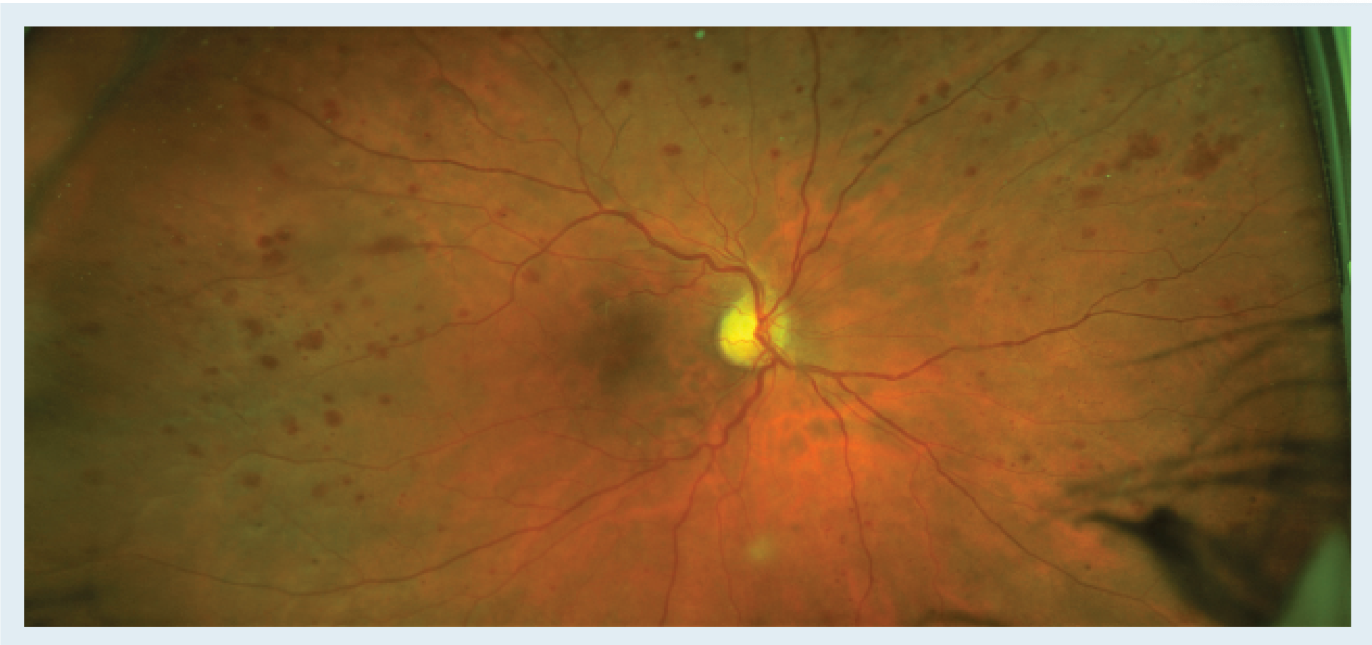 Figure. Here is an example of a patient with predominantly peripheral lesions using ultra-widefield color retinal imaging. Although DRCR.net Protocol AA found that this does not predict significant progression over 4 years, the abundance of peripheral lesions seen here compared to those seen in the posterior pole supports a diagnosis of severe nonproliferative diabetic retinopathy, as well as closer monitoring and/or referral to a retinal specialist and consideration for anti-VEGF therapy. (Image courtesy of A. Paul Chous, OD, MA, FAAO)